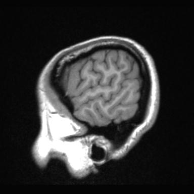Atretic encephalocoele with inferior vermis hypoplasia (Radiopaedia 30443-31108 Sagittal T1 10).jpg