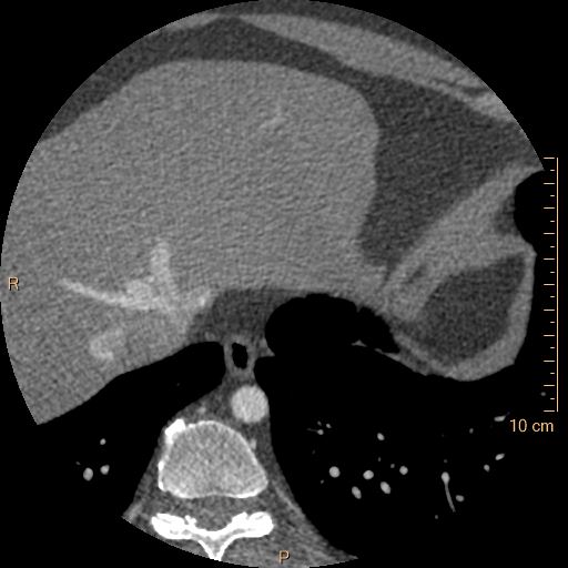 Atrial septal defect (upper sinus venosus type) with partial anomalous pulmonary venous return into superior vena cava (Radiopaedia 73228-83961 A 261).jpg
