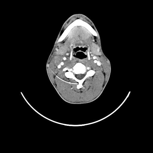 File:Atypical 2nd branchial cleft cyst (type IV) - infected (Radiopaedia 20986-20924 A 14).jpg