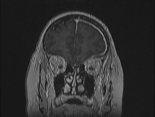 Atypical meningioma (Radiopaedia 62985-71406 Coronal T1 C+ 21).jpg