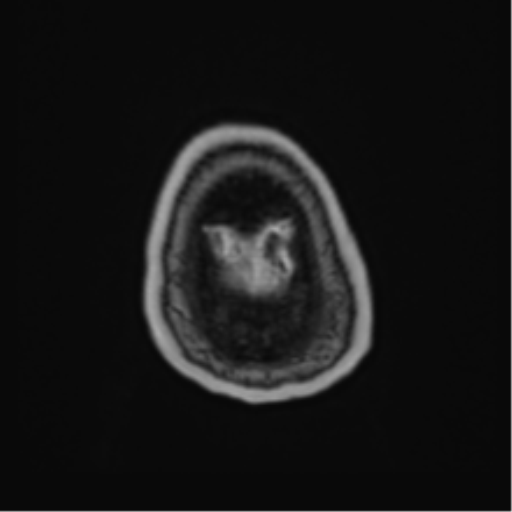 Atypical meningioma (WHO Grade II) (Radiopaedia 54742-60981 Axial T1 C+ 68).png
