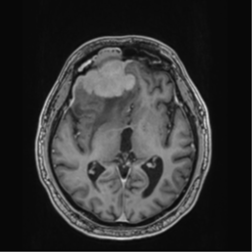 Atypical meningioma (WHO grade II) with brain invasion (Radiopaedia 57767-64729 Axial T1 C+ 23).png