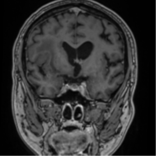 File:Atypical meningioma (WHO grade II) with brain invasion (Radiopaedia 57767-64729 Coronal T1 C+ 37).png