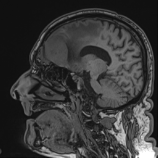 Atypical meningioma (WHO grade II) with brain invasion (Radiopaedia 57767-64729 Sagittal T1 40).png