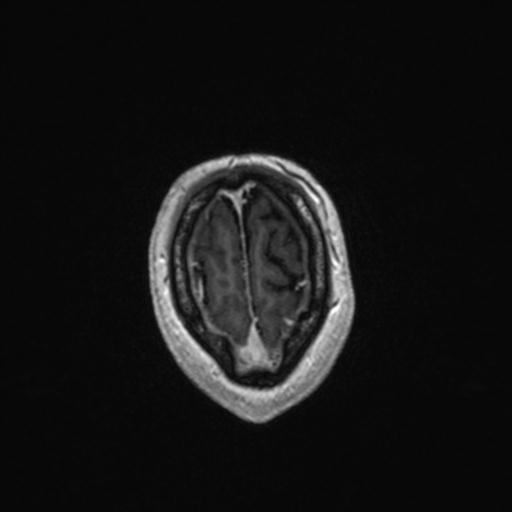 Atypical meningioma (grade II) - en plaque (Radiopaedia 29633-30147 Axial T1 C+ 163).jpg