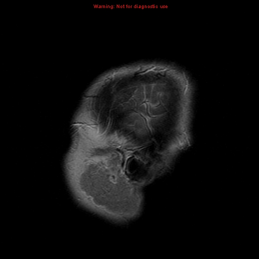File:Atypical meningioma - grade II (Radiopaedia 13303-13305 Sagittal T2 22).jpg