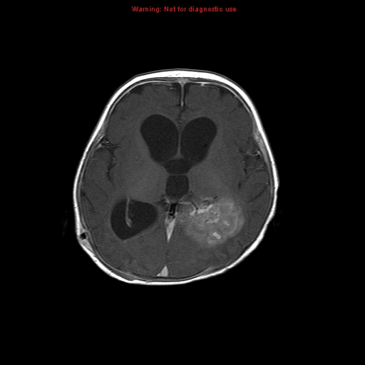 File:Atypical teratoid rhabdoid tumor (Radiopaedia 10712-11183 Axial T1 C+ 9).jpg