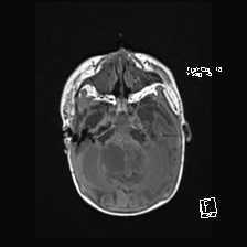 Atypical teratoid rhabdoid tumor (prenatal US and neonatal MRI) (Radiopaedia 59091-66388 Axial T1 17).jpg