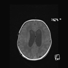 Atypical teratoid rhabdoid tumor (prenatal US and neonatal MRI) (Radiopaedia 59091-66388 Axial T1 40).jpg