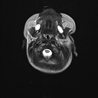 File:Atypical teratoid rhabdoid tumor (prenatal US and neonatal MRI) (Radiopaedia 59091-66388 Axial T2 4).jpg