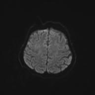 Autoimmune limbic encephalitis (Radiopaedia 30363-31005 Axial B0 and DWI 57).jpg