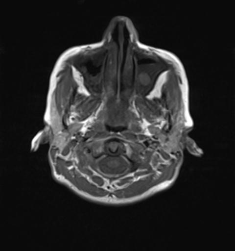 File:Autoimmune limbic encephalitis (Radiopaedia 30363-31005 Axial T1 1).jpg