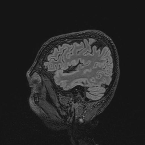 File:Autoimmune limbic encephalitis (Radiopaedia 30363-31005 Sagittal FLAIR 123).jpg