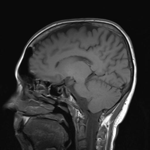 File:Autoimmune limbic encephalitis (Radiopaedia 30363-31005 Sagittal T1 11).jpg
