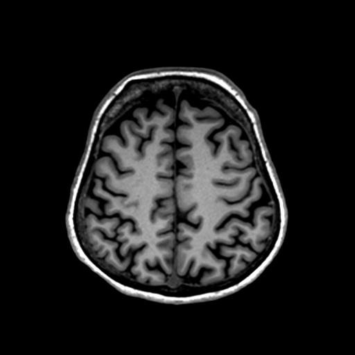 Autoimmune limbic encephalitis (Radiopaedia 30363-31005 T1 Axial 1mm 115).jpg