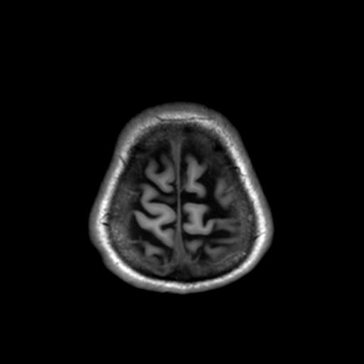 Autoimmune limbic encephalitis (Radiopaedia 30363-31005 T1 Axial 3mm 46).jpg