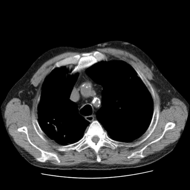Autosomal dominant polycystic kidney disease (Radiopaedia 27851-28094 Axial non-contrast 13).jpg