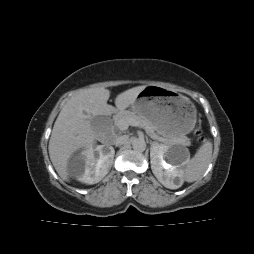 Autosomal dominant polycystic kidney disease (Radiopaedia 38189-40194 Axial C+ delayed 14).jpg