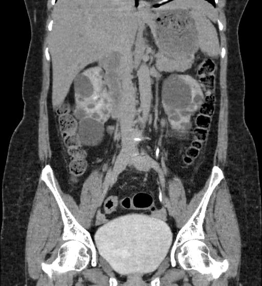 Autosomal dominant polycystic kidney disease (Radiopaedia 38189-40194 Coronal C+ delayed 44).jpg