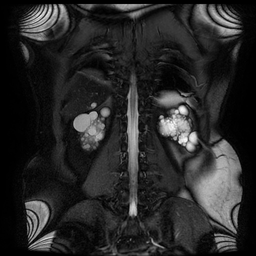 File:Autosomal dominant polycystic kidney disease (Radiopaedia 50259-55611 Coronal FIESTA 26).jpg
