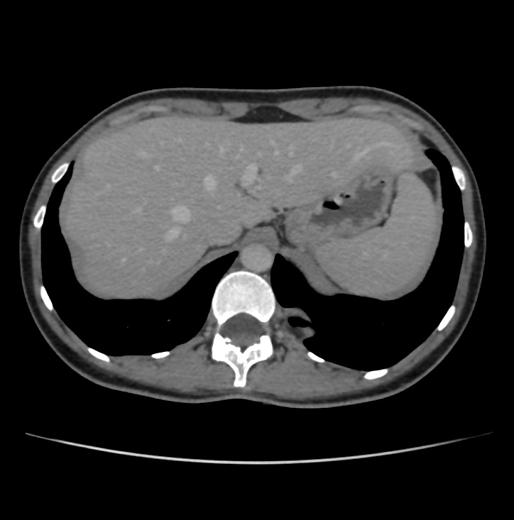Autosomal dominant polycystic kidney disease - early onset (Radiopaedia 40734-43387 A 3).jpg