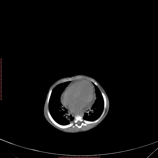 Autosomal recessive polycystic kidney disease associated with Caroli disease (Radiopaedia 61932-69984 B 76).jpg