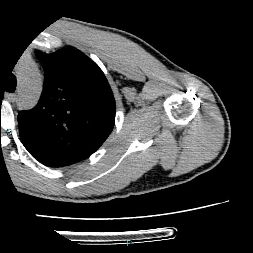 File:Avascular necrosis after fracture dislocations of the proximal humerus (Radiopaedia 88078-104655 D 61).jpg