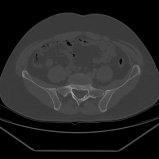 File:Avascular necrosis of the hip (Radiopaedia 61503-69467 Axial bone window 8).jpg