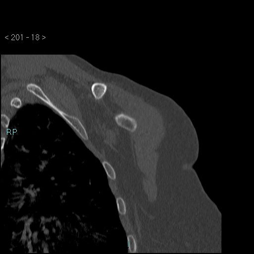 Avascular necrosis of the shoulder - Cruess stage I (Radiopaedia 77674-89887 Coronal bone window 17).jpg