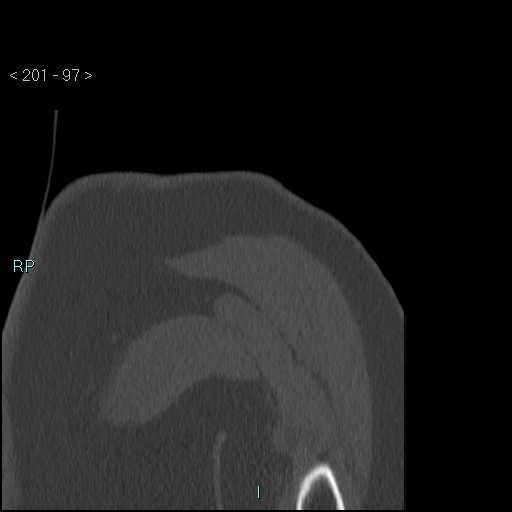 Avascular necrosis of the shoulder - Cruess stage I (Radiopaedia 77674-89887 Coronal bone window 96).jpg