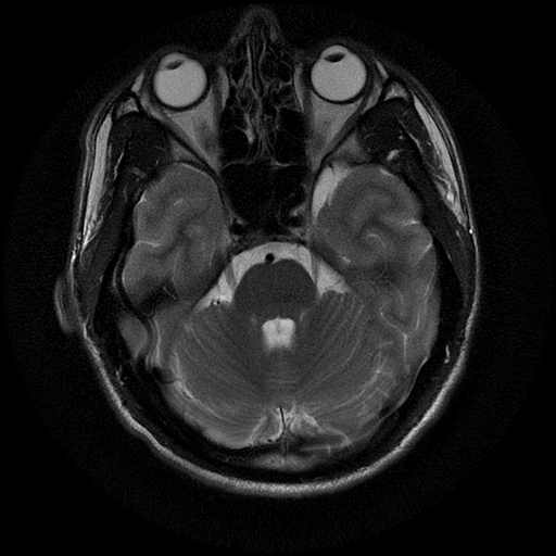 File:Azygos anterior cerebral artery (Radiopaedia 17059-16756 Axial T2 18).jpg