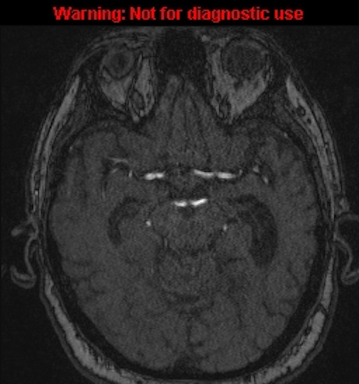 Azygos anterior cerebral artery (Radiopaedia 59325-66677 Axial MRA 66).jpg