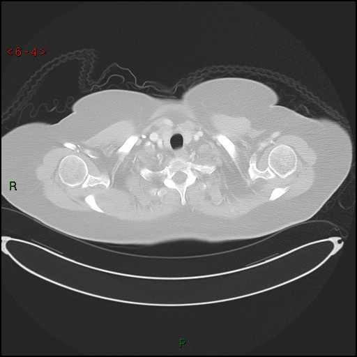 Azygos fissure and lobe (Radiopaedia 47620-52278 Axial lung window 4).jpg