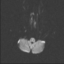 Balo concentric sclerosis (Radiopaedia 50458-55940 Axial DWI 65).jpg