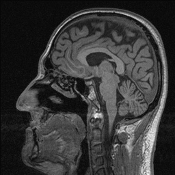 Balo concentric sclerosis (Radiopaedia 50458-55940 Sagittal T1 84).jpg