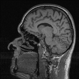 Balo concentric sclerosis (Radiopaedia 50458-55940 Sagittal T1 90).jpg