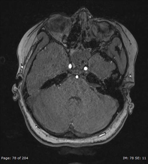 Balo concentric sclerosis (Radiopaedia 61637-69636 Axial MRA 78).jpg