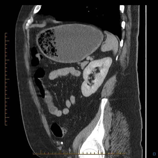 File:Bariatric balloon causing gastric outlet obstruction (Radiopaedia 54449-60672 C 22).jpg