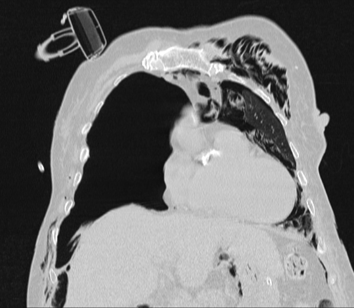Barotrauma due to mechanical ventilation (Radiopaedia 28079-28336 Coronal lung window 33).jpg