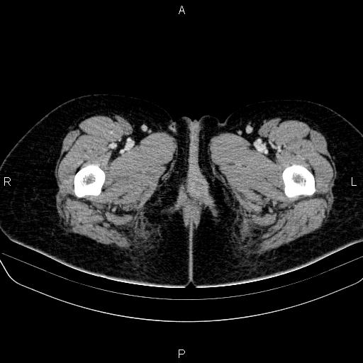 File:Bartholin gland cyst (Radiopaedia 62635-70930 Axial Post contrast 101).jpg
