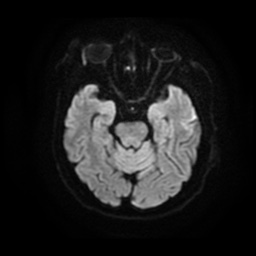 File:Basal cell carcinoma (periorbital) (Radiopaedia 55179-61559 Axial DWI 9).jpg