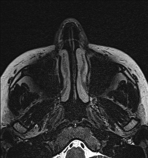 Basal cell carcinoma - nasal region (Radiopaedia 70292-80365 Axial Gradient Echo 3).jpg