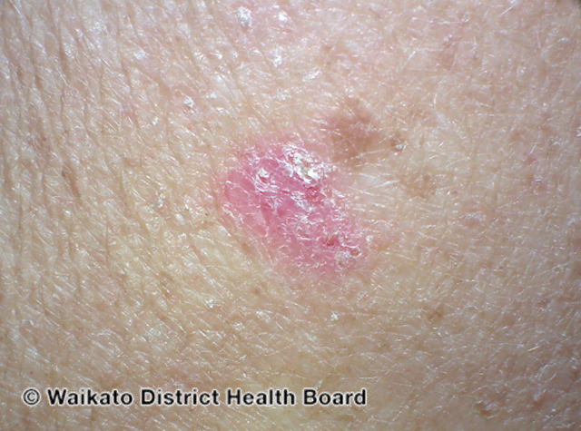 File:Basal cell carcinoma affecting the arms and legs 7 macro (DermNet NZ bcc-7-macro).jpg