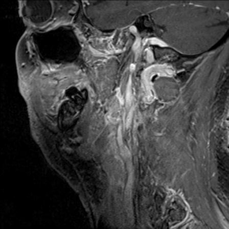 File:Base of tongue squamous cell carcinoma (Radiopaedia 31174-31884 F 52).jpg