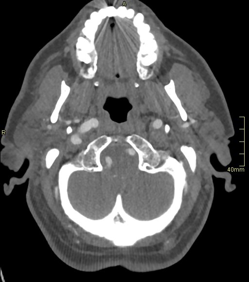 Basilar artery aneurysm (Radiopaedia 56261-62932 A 36).jpg