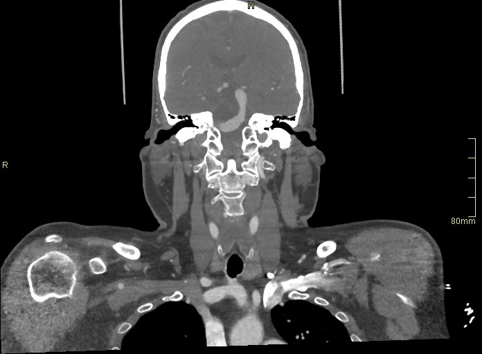 Basilar artery aneurysm (Radiopaedia 56261-62932 B 26).jpg