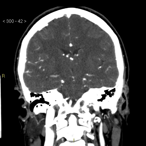 Basilar artery thrombosis (Radiopaedia 16260-15944 B 33).jpg