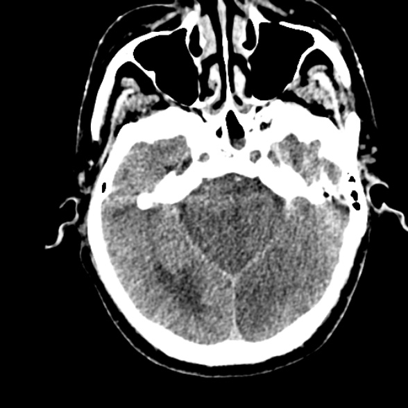 File:Basilar artery thrombosis (Radiopaedia 53351-59352 Axial non-contrast 42).jpg