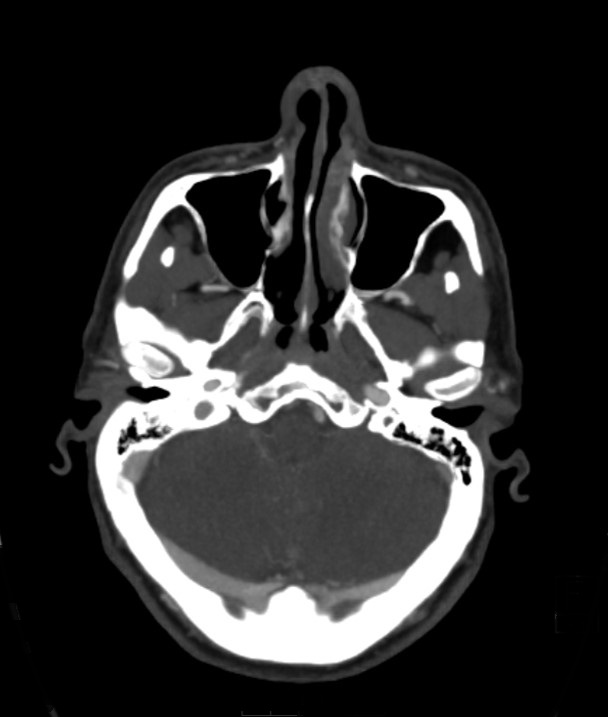 Basilar artery thrombosis and ascending transtentorial herniation (Radiopaedia 84759-100360 B 49).jpg