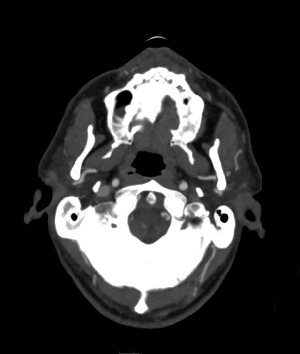 Basilar artery thrombosis and ascending transtentorial herniation (Radiopaedia 84759-100360 B 58).jpg